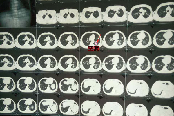 中医怎么治疗肺结核