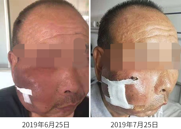 1605918379390150.jpg 皮肤结核12.jpg
