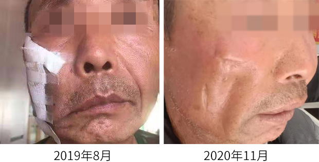 1605918402445041.jpg 皮肤结核21.jpg